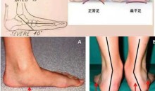 张美玲 扁平足 精准评估与处理方案